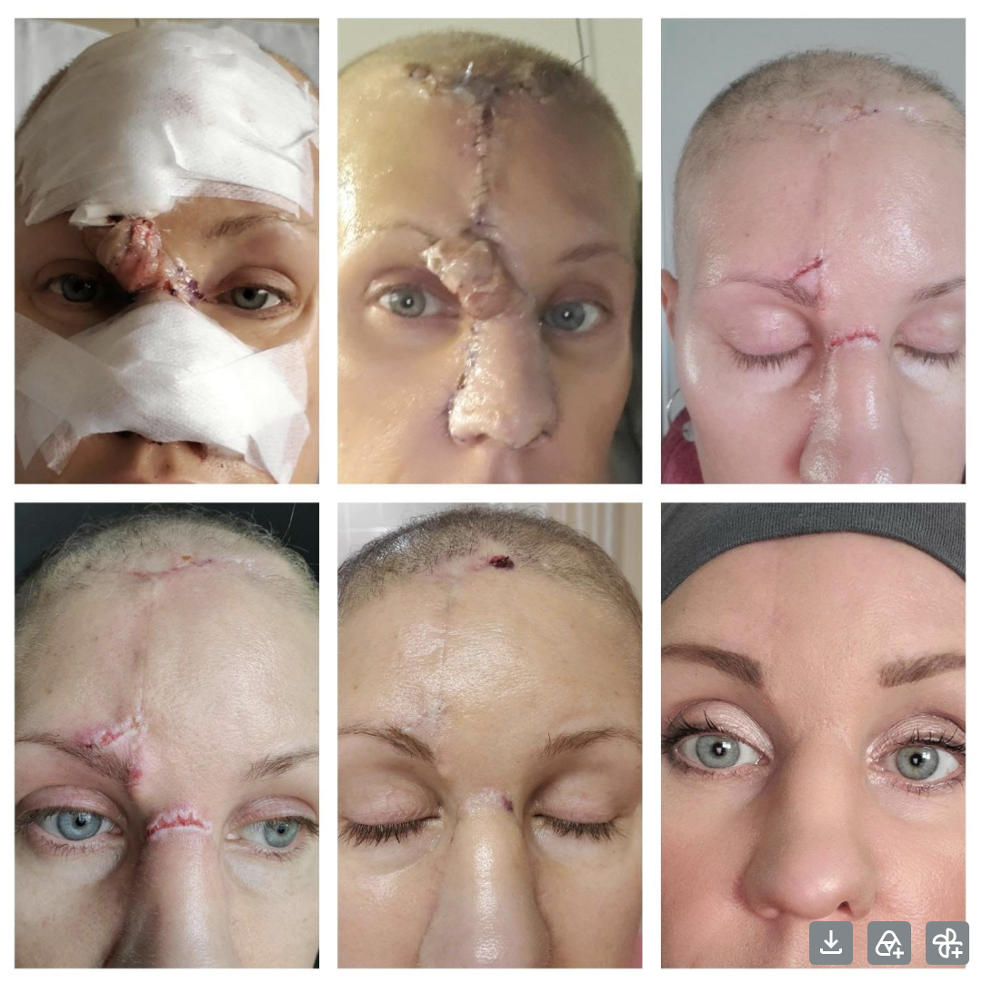 Tiffany's healing journey following nasal reconstruction surgery