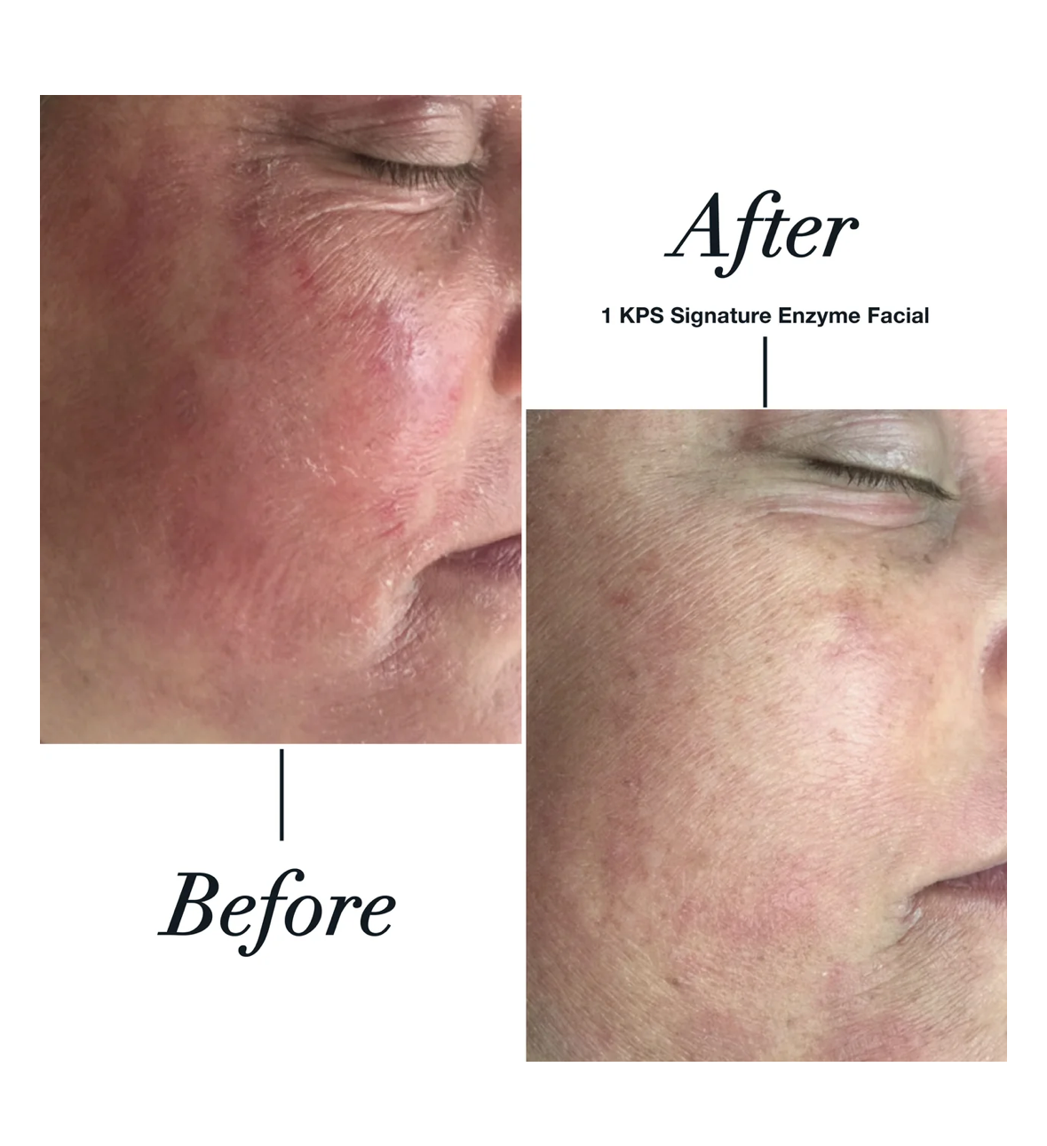 Before and after photos showing rosacea reduction following one KPS Signature Enzyme Facial